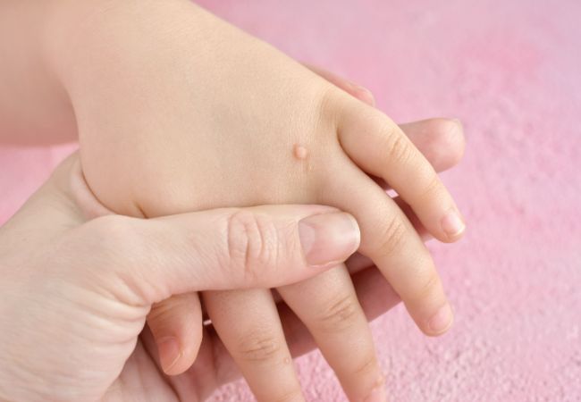 できものができた子供の手